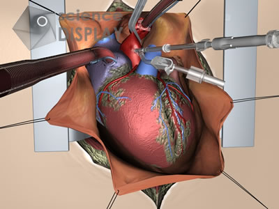 Situs - Heart with Catheters